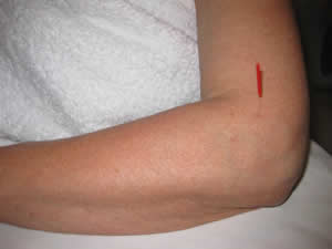 One of the acupuncture points for tennis elbow
