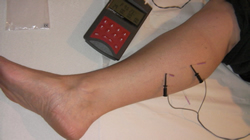 Electro Acupuncture for pain after leg cramp in the right leg